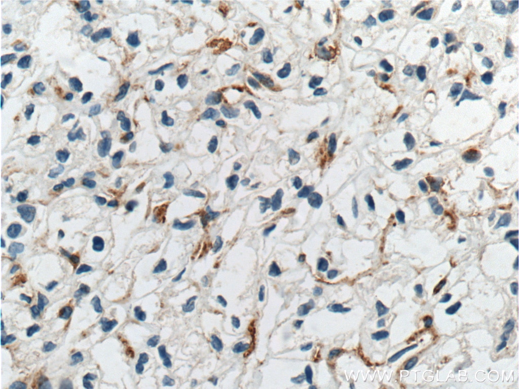 Immunohistochemistry (IHC) staining of human renal cell carcinoma tissue using TEM1 Monoclonal antibody (60170-1-Ig)