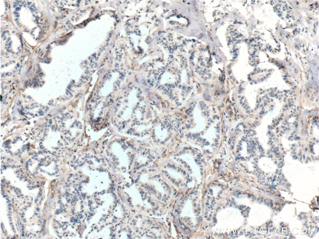 Immunohistochemistry (IHC) staining of human breast cancer tissue using TEM1 Monoclonal antibody (60170-1-Ig)