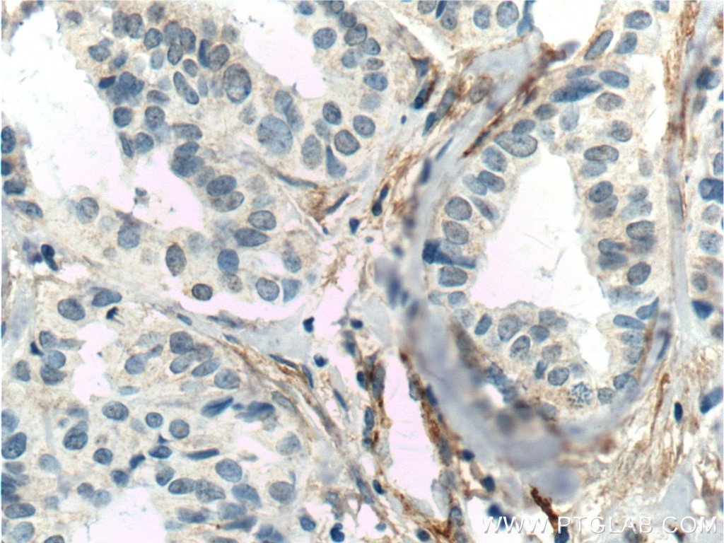 Immunohistochemistry (IHC) staining of human breast cancer tissue using TEM1 Monoclonal antibody (60170-1-Ig)