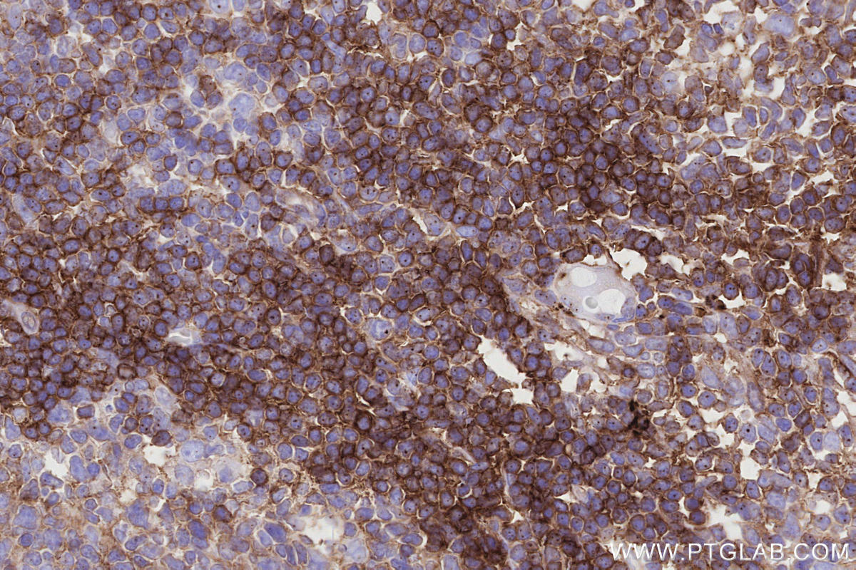 Immunohistochemistry (IHC) staining of human tonsillitis tissue using CD268/BAFF-R Monoclonal antibody (60763-7-Ig)