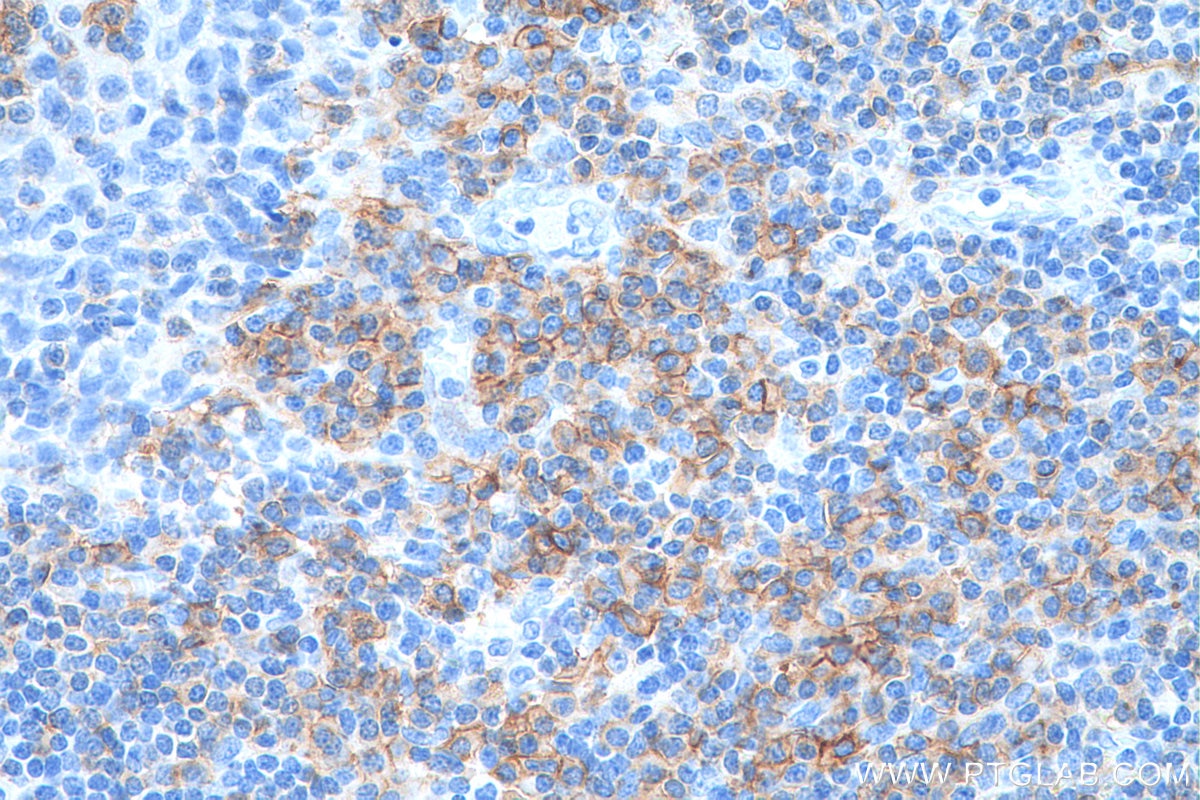 Immunohistochemistry (IHC) staining of human tonsillitis tissue using CD27 Monoclonal antibody (66308-1-Ig)