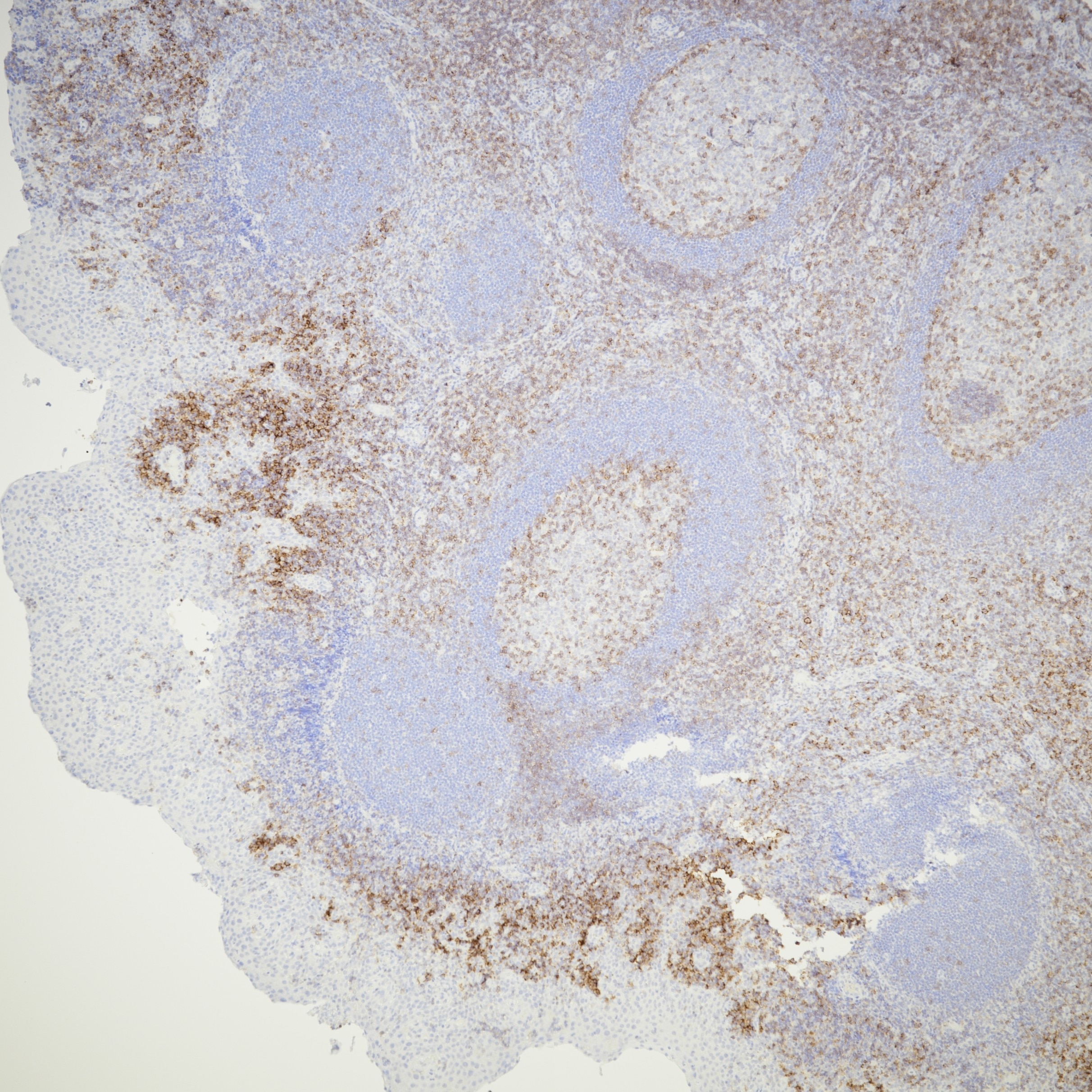 IHC staining of human tonsil using 66308-1-Ig Immunohistochemistry (IHC) staining of human tonsil tissue using CD27 Monoclonal antibody (66308-1-Ig)
