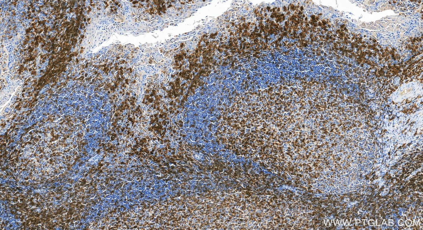 Immunohistochemical analysis of paraffin-embedded human tonsillitis tissue slide using 85066-5-RR (CD27 antibody) at dilution of 1:500 (under 20x lens). Heat mediated antigen retrieval with Tris-EDTA buffer (pH 9.0). Immunohistochemistry (IHC) staining of human tonsillitis tissue using CD27 Recombinant monoclonal antibody (85066-5-RR)