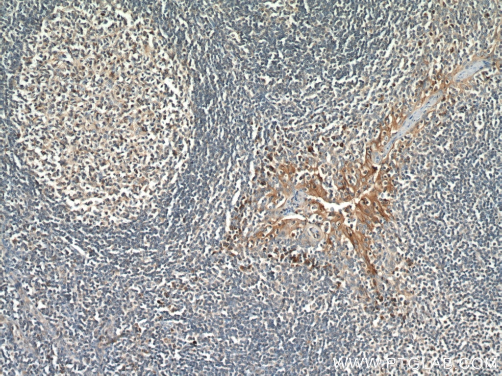 Immunohistochemistry (IHC) staining of human tonsillitis tissue using PD-L1/CD274 Polyclonal antibody (17952-1-AP)