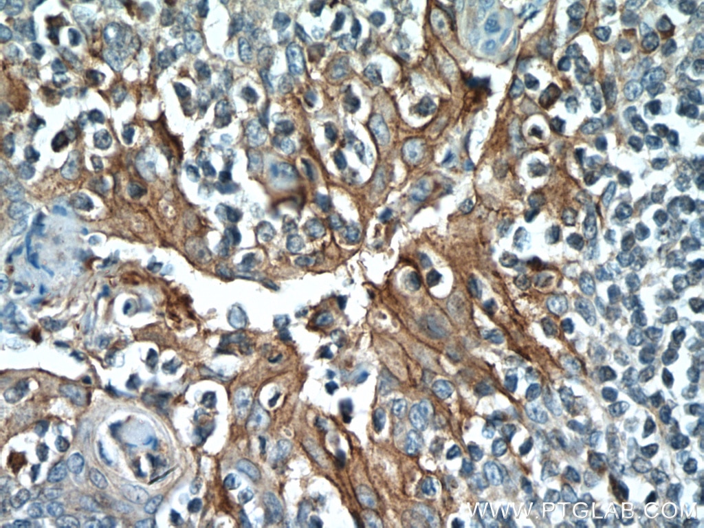 Immunohistochemistry (IHC) staining of human tonsillitis tissue using PD-L1/CD274 Polyclonal antibody (17952-1-AP)