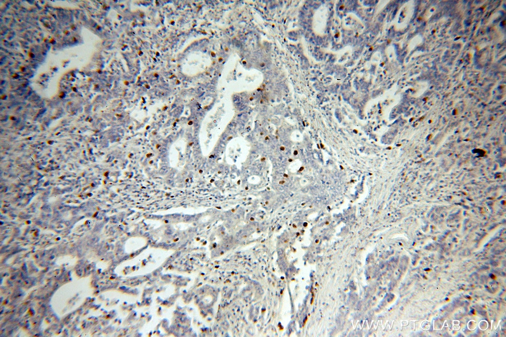 Immunohistochemistry (IHC) staining of human stomach cancer tissue using PD-L1/CD274 Polyclonal antibody (17952-1-AP)
