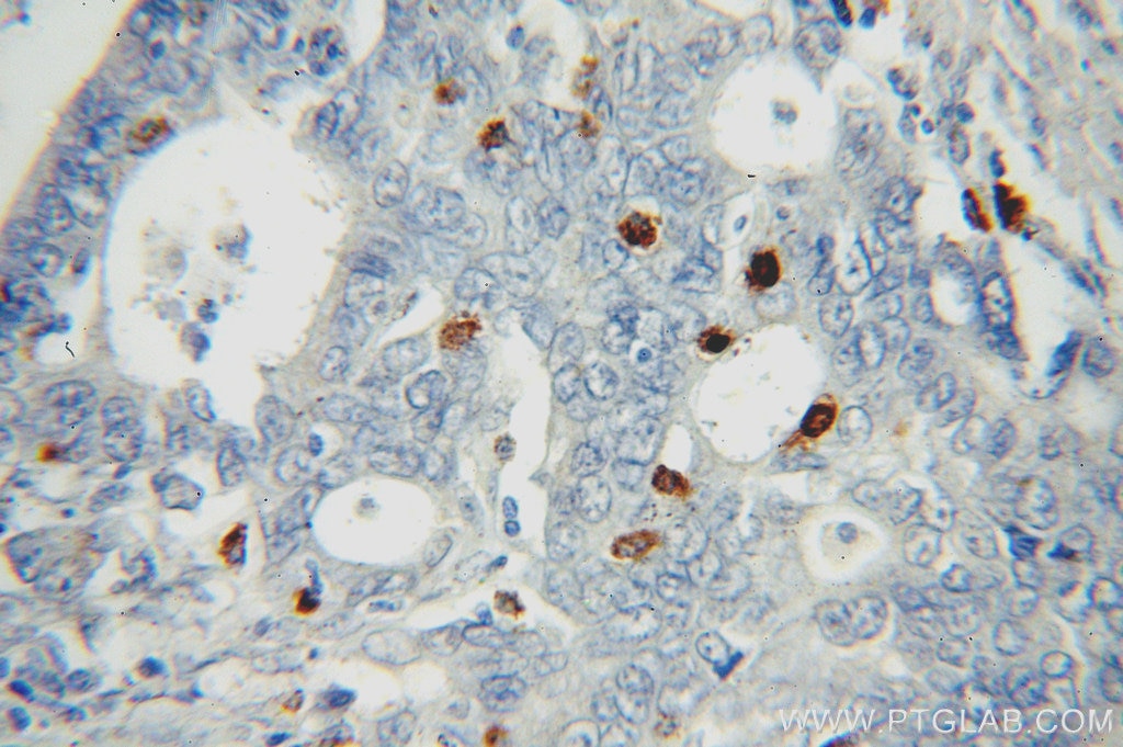 Immunohistochemistry (IHC) staining of human stomach cancer tissue using PD-L1/CD274 Polyclonal antibody (17952-1-AP)