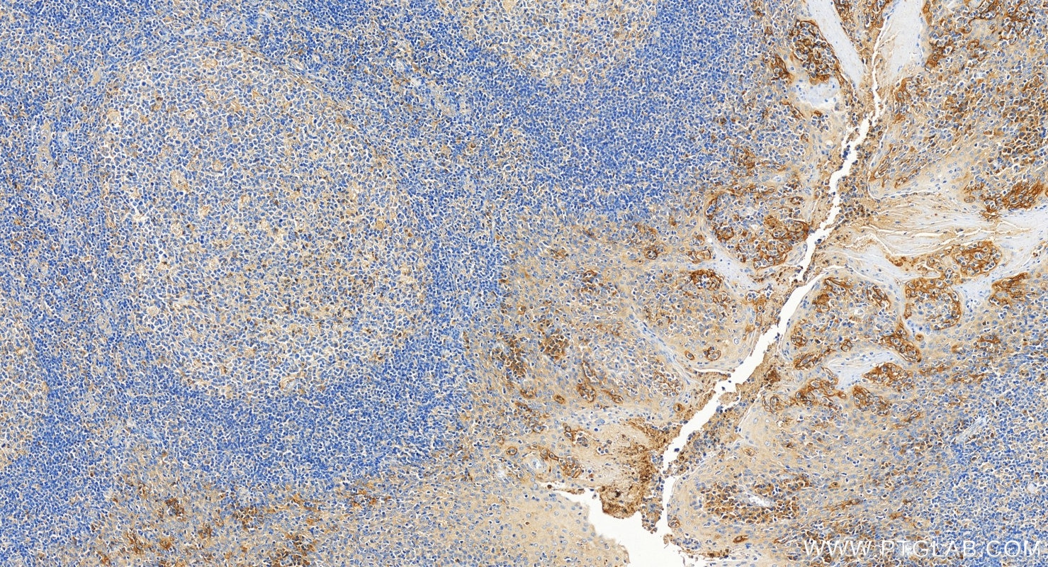 Immunohistochemistry (IHC) staining of human tonsillitis tissue using PD-L1/CD274 Polyclonal antibody (17952-1-AP)