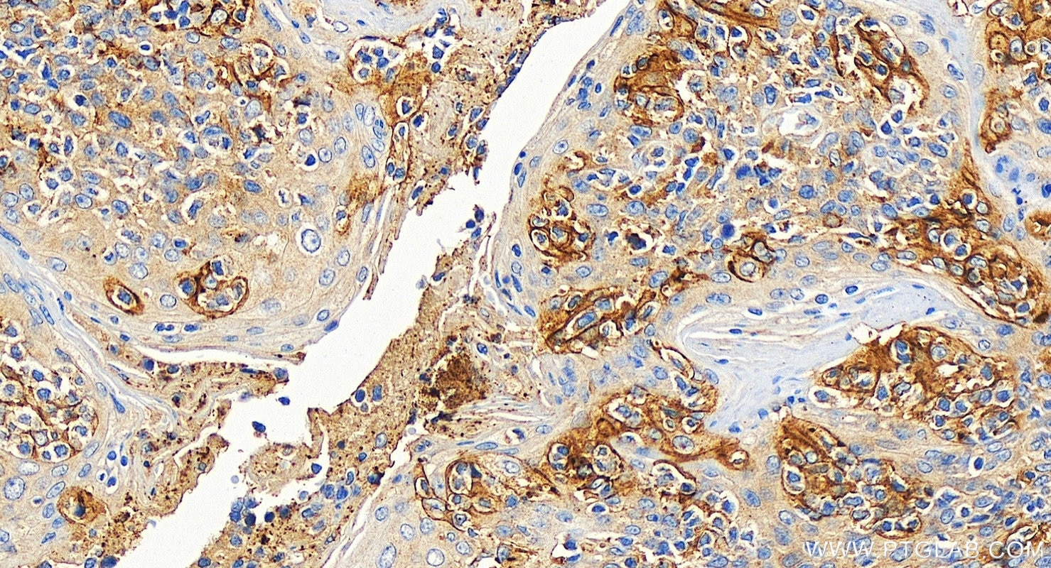 Immunohistochemistry (IHC) staining of human tonsillitis tissue using PD-L1/CD274 Polyclonal antibody (17952-1-AP)
