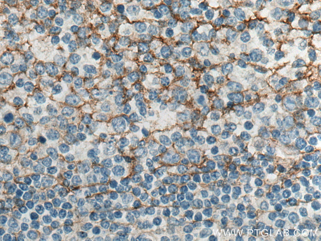 Immunohistochemistry (IHC) staining of human tonsillitis tissue using B7-H3 Polyclonal antibody (14453-1-AP)