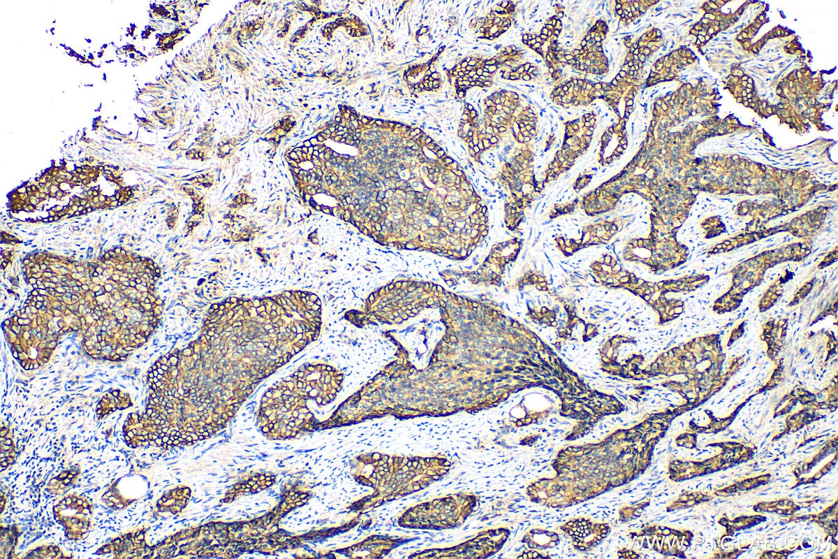 Immunohistochemistry (IHC) staining of human prostate cancer tissue using B7-H3 Polyclonal antibody (14453-1-AP)