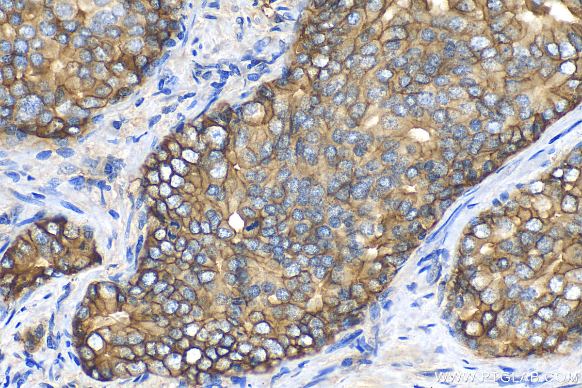 Immunohistochemistry (IHC) staining of human prostate cancer tissue using B7-H3/CD276 Polyclonal antibody (14453-1-AP)