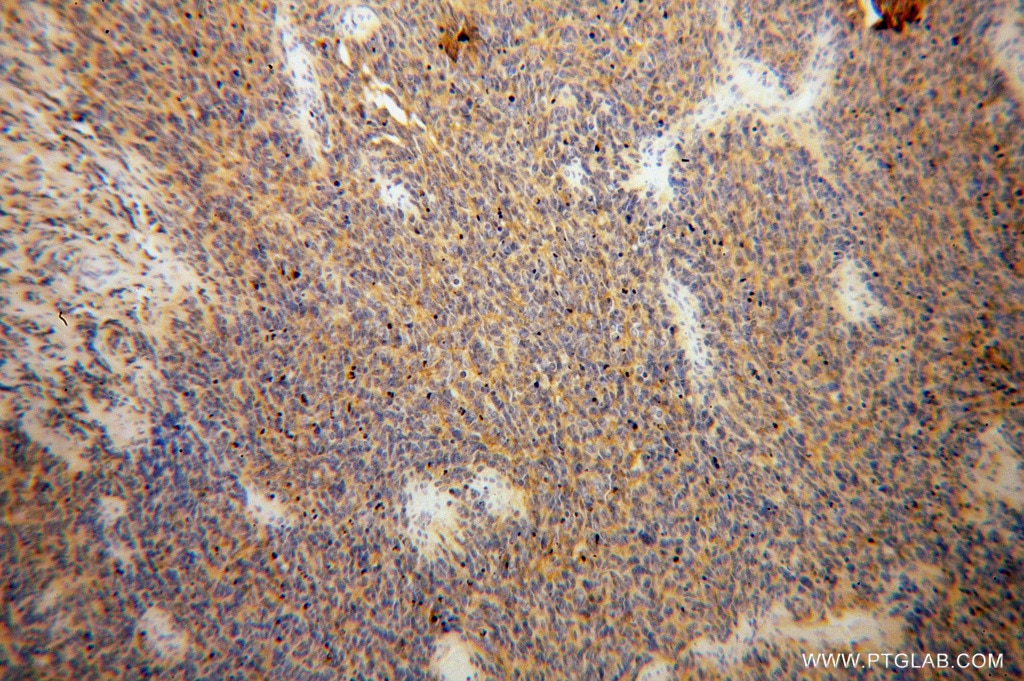 Immunohistochemistry (IHC) staining of human medulloblastoma tissue using B7-H3 Polyclonal antibody (14453-1-AP)