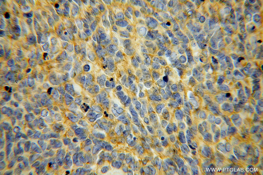 Immunohistochemistry (IHC) staining of human medulloblastoma tissue using B7-H3 Polyclonal antibody (14453-1-AP)