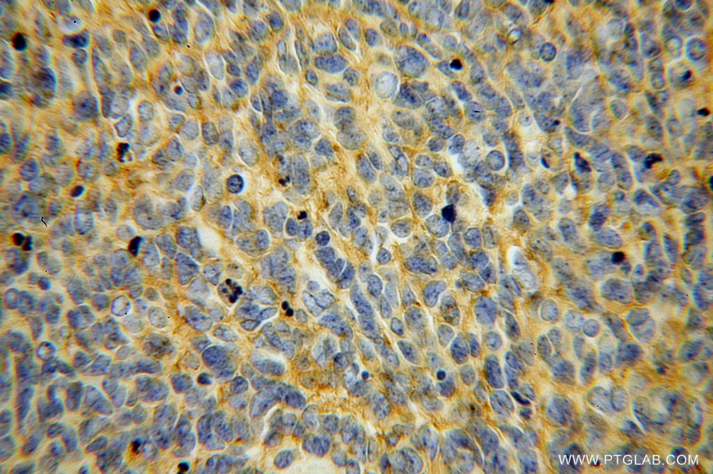 Immunohistochemistry (IHC) staining of human medulloblastoma tissue using B7-H3/CD276 Polyclonal antibody (14453-1-AP)