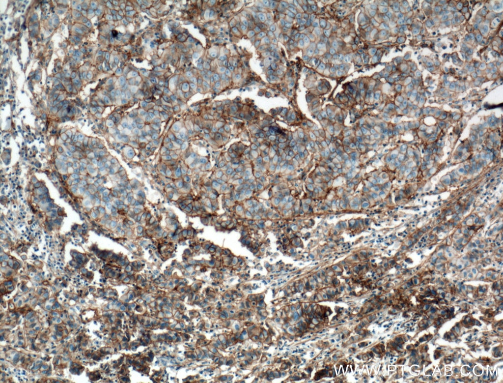 Immunohistochemistry (IHC) staining of human prostate cancer tissue using B7-H3 Monoclonal antibody (66481-1-Ig)