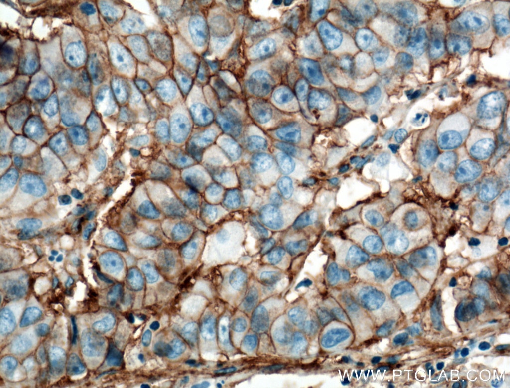 Immunohistochemistry (IHC) staining of human prostate cancer tissue using B7-H3 Monoclonal antibody (66481-1-Ig)