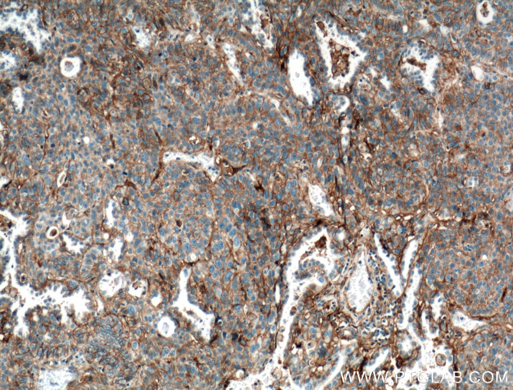 Immunohistochemistry (IHC) staining of human lung cancer tissue using B7-H3/CD276 Monoclonal antibody (66481-1-Ig)