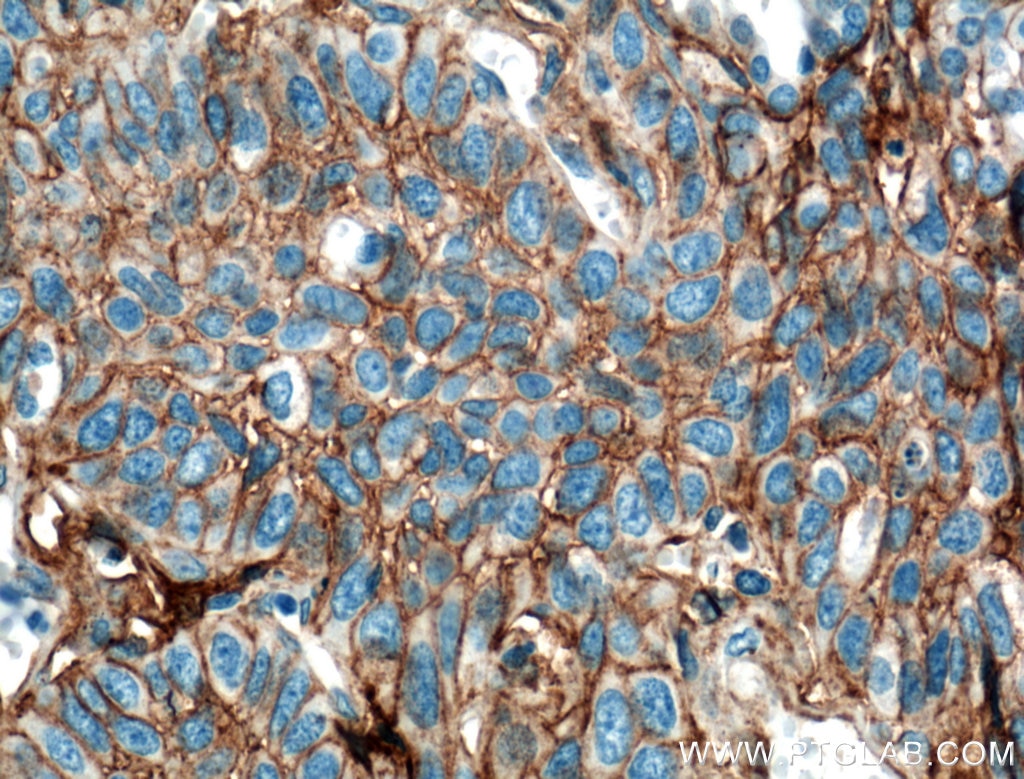 Immunohistochemistry (IHC) staining of human lung cancer tissue using B7-H3/CD276 Monoclonal antibody (66481-1-Ig)