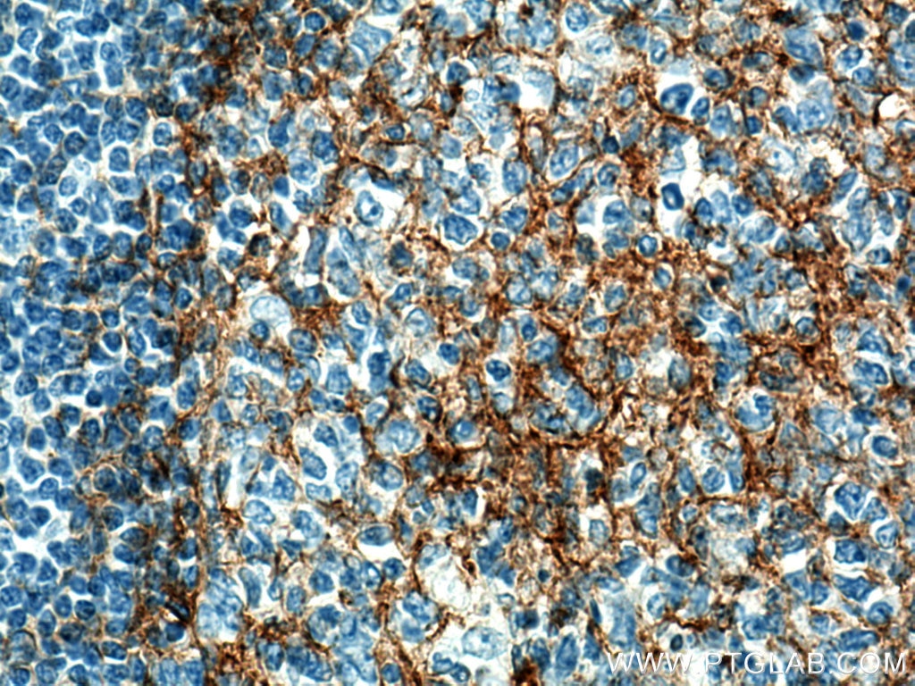 Immunohistochemistry (IHC) staining of human tonsillitis tissue using B7-H3/CD276 Monoclonal antibody (66481-1-Ig)