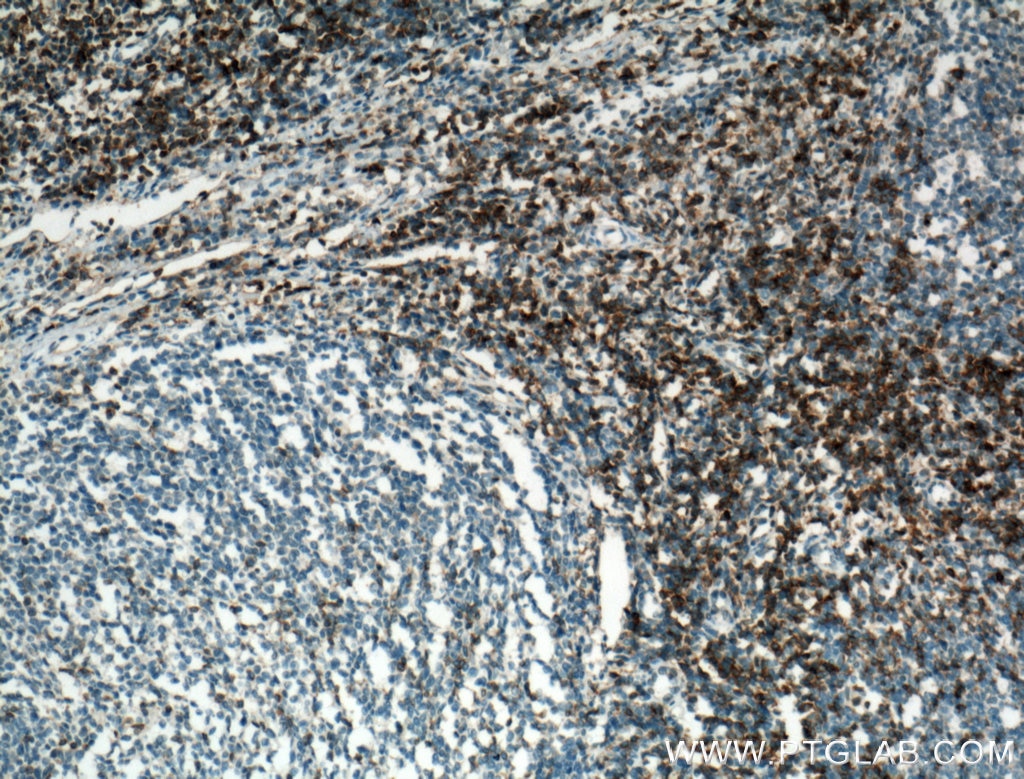 Immunohistochemistry (IHC) staining of human tonsillitis tissue using CD28 Polyclonal antibody (26174-1-AP)