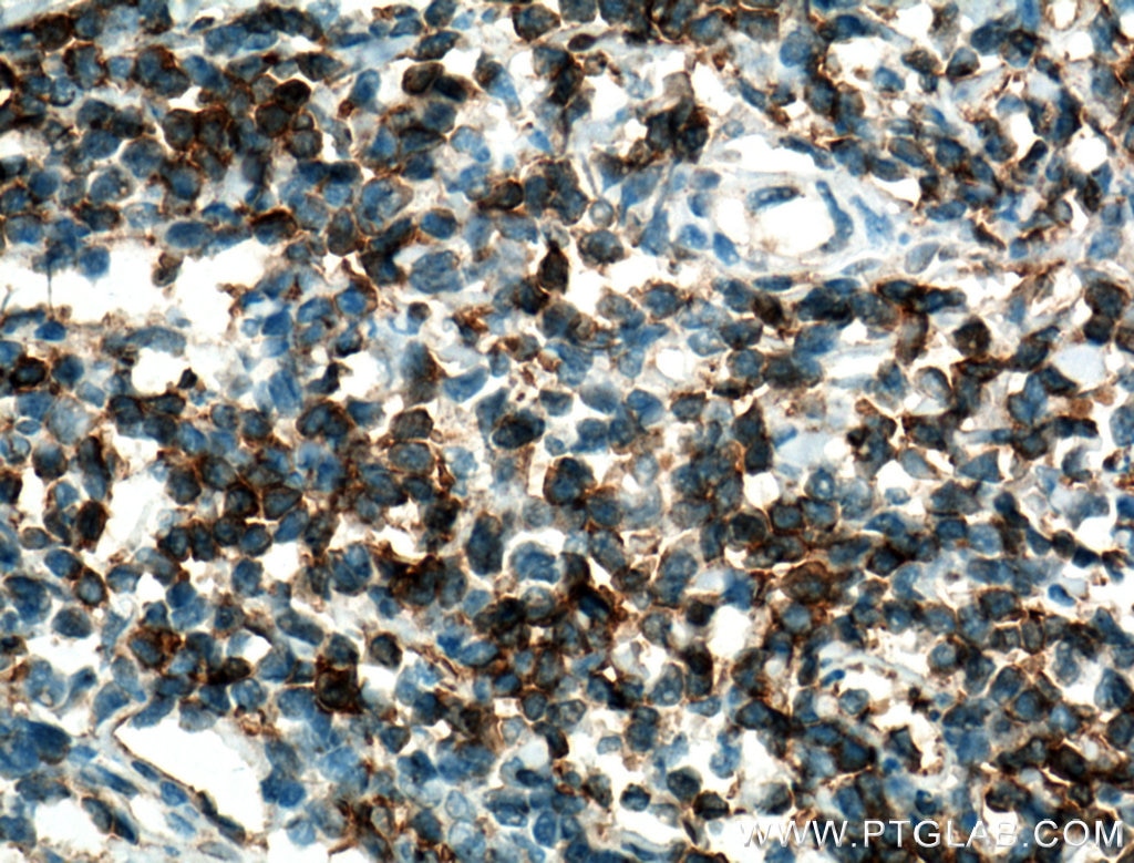 Immunohistochemistry (IHC) staining of human tonsillitis tissue using CD28 Polyclonal antibody (26174-1-AP)
