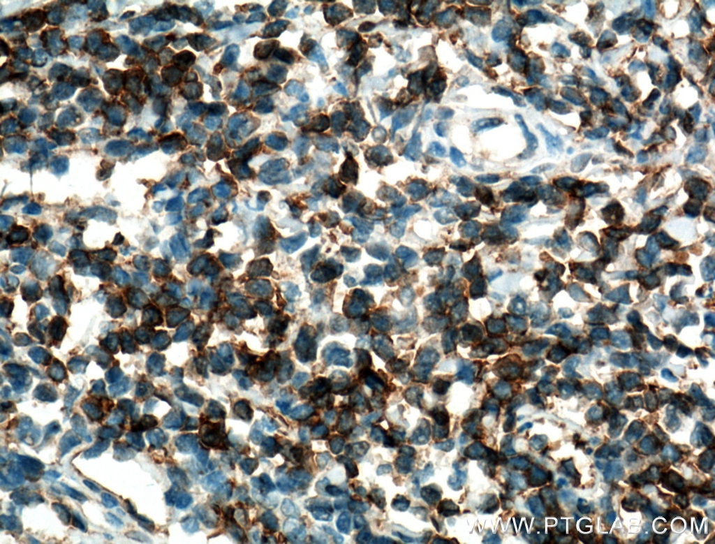 IHC staining of human tonsillitis using 26174-1-AP