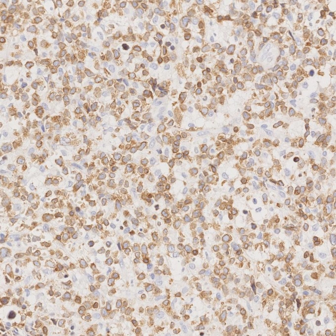 IHC staining of human lymphoma using 81324-1-RR Immunohistochemistry (IHC) staining of human lymphoma tissue using CD3 Recombinant monoclonal antibody (81324-1-RR)