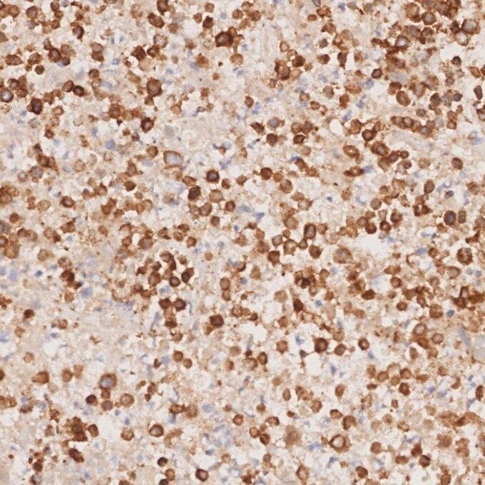 IHC staining of human lymphoma using 81324-1-RR Immunohistochemistry (IHC) staining of human lymphoma tissue using CD3 Recombinant monoclonal antibody (81324-1-RR)