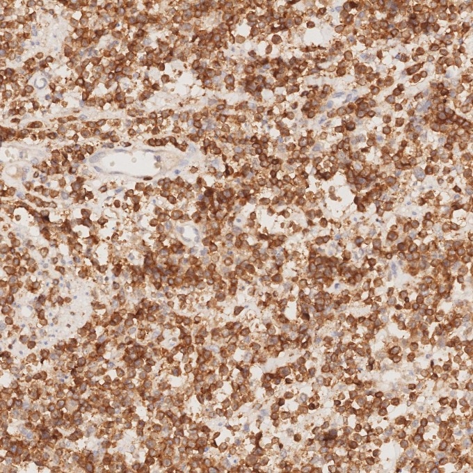 IHC staining of human lymphoma using 81324-1-RR Immunohistochemistry (IHC) staining of human lymphoma tissue using CD3 Recombinant monoclonal antibody (81324-1-RR)