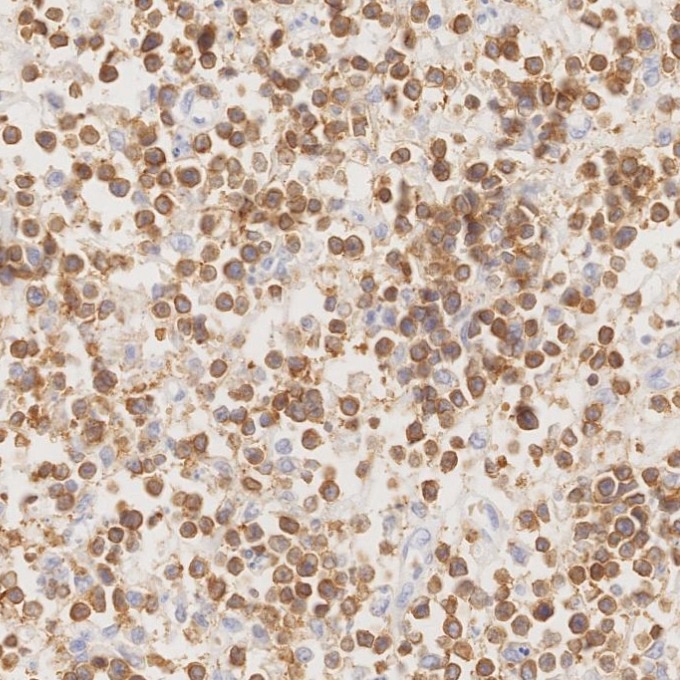 IHC staining of human lymphoma using 81324-1-RR Immunohistochemistry (IHC) staining of human lymphoma tissue using CD3 Recombinant monoclonal antibody (81324-1-RR)