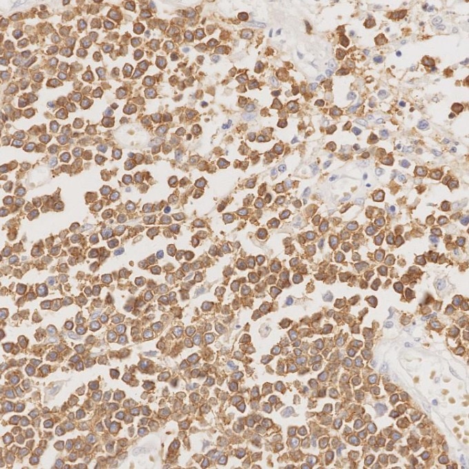 IHC staining of human lymphoma using 81324-1-RR Immunohistochemistry (IHC) staining of human lymphoma tissue using CD3 Recombinant monoclonal antibody (81324-1-RR)