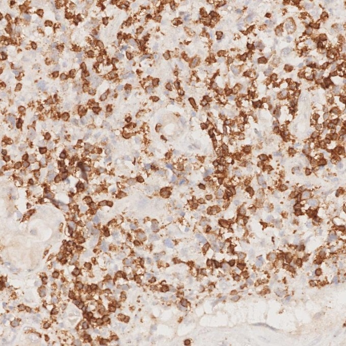 IHC staining of human lymphoma using 81324-1-RR Immunohistochemistry (IHC) staining of human lymphoma tissue using CD3 Recombinant monoclonal antibody (81324-1-RR)