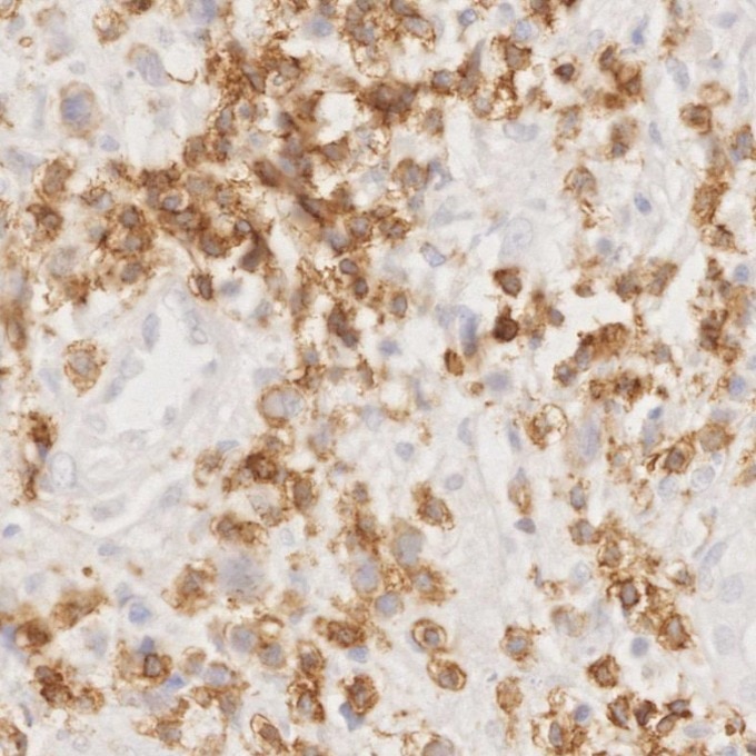 IHC staining of human lymphoma using 81324-1-RR Immunohistochemistry (IHC) staining of human lymphoma tissue using CD3 Recombinant monoclonal antibody (81324-1-RR)