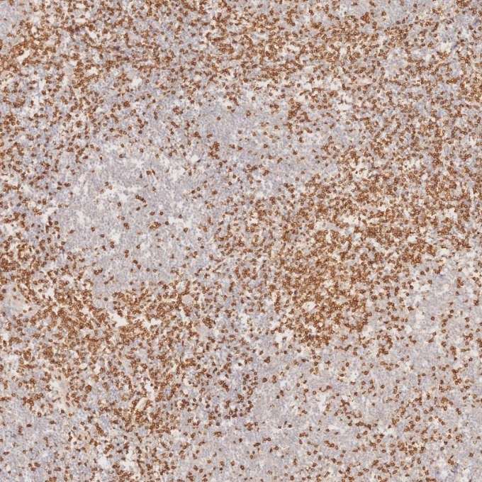 IHC staining of human lymphoma using 81324-1-RR Immunohistochemistry (IHC) staining of human lymphoma tissue using CD3 Recombinant monoclonal antibody (81324-1-RR)