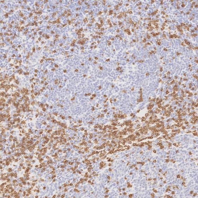 IHC staining of human lymphoma using 81324-1-RR Immunohistochemistry (IHC) staining of human lymphoma tissue using CD3 Recombinant monoclonal antibody (81324-1-RR)