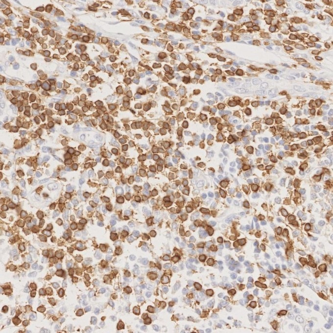 IHC staining of human lymphoma using 81324-1-RR Immunohistochemistry (IHC) staining of human lymphoma tissue using CD3 Recombinant monoclonal antibody (81324-1-RR)