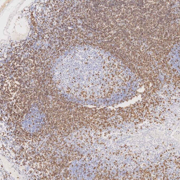 IHC staining of human tonsillitis using 81324-1-RR Immunohistochemistry (IHC) staining of human tonsillitis tissue using CD3 Recombinant monoclonal antibody (81324-1-RR)