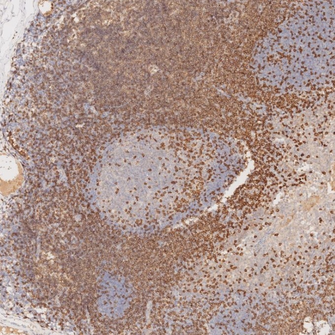 IHC staining of human tonsillitis using 81324-1-RR Immunohistochemistry (IHC) staining of human tonsillitis tissue using CD3 Recombinant monoclonal antibody (81324-1-RR)