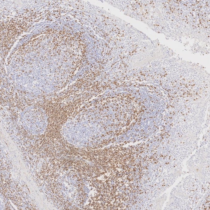 IHC staining of human tonsillitis using 81324-1-RR Immunohistochemistry (IHC) staining of human tonsillitis tissue using CD3 Recombinant monoclonal antibody (81324-1-RR)