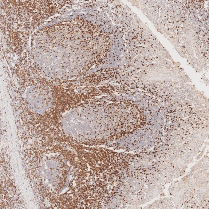 IHC staining of human tonsillitis using 81324-1-RR Immunohistochemistry (IHC) staining of human tonsillitis tissue using CD3 Recombinant monoclonal antibody (81324-1-RR)