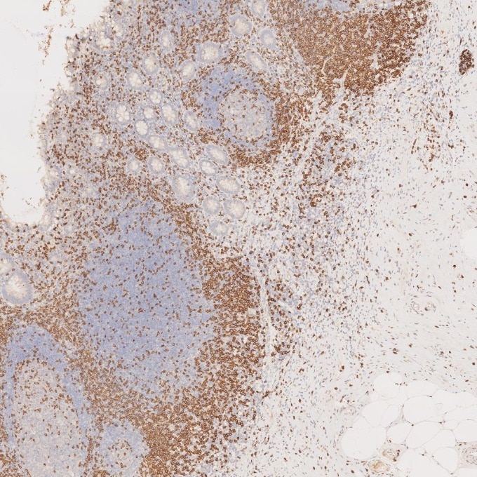 IHC staining of human appendicitis using 81324-1-RR Immunohistochemistry (IHC) staining of human appendicitis tissue using CD3 Recombinant monoclonal antibody (81324-1-RR)
