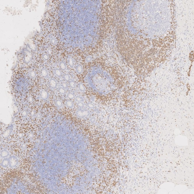 IHC staining of human appendicitis using 81324-1-RR Immunohistochemistry (IHC) staining of human appendicitis tissue using CD3 Recombinant monoclonal antibody (81324-1-RR)