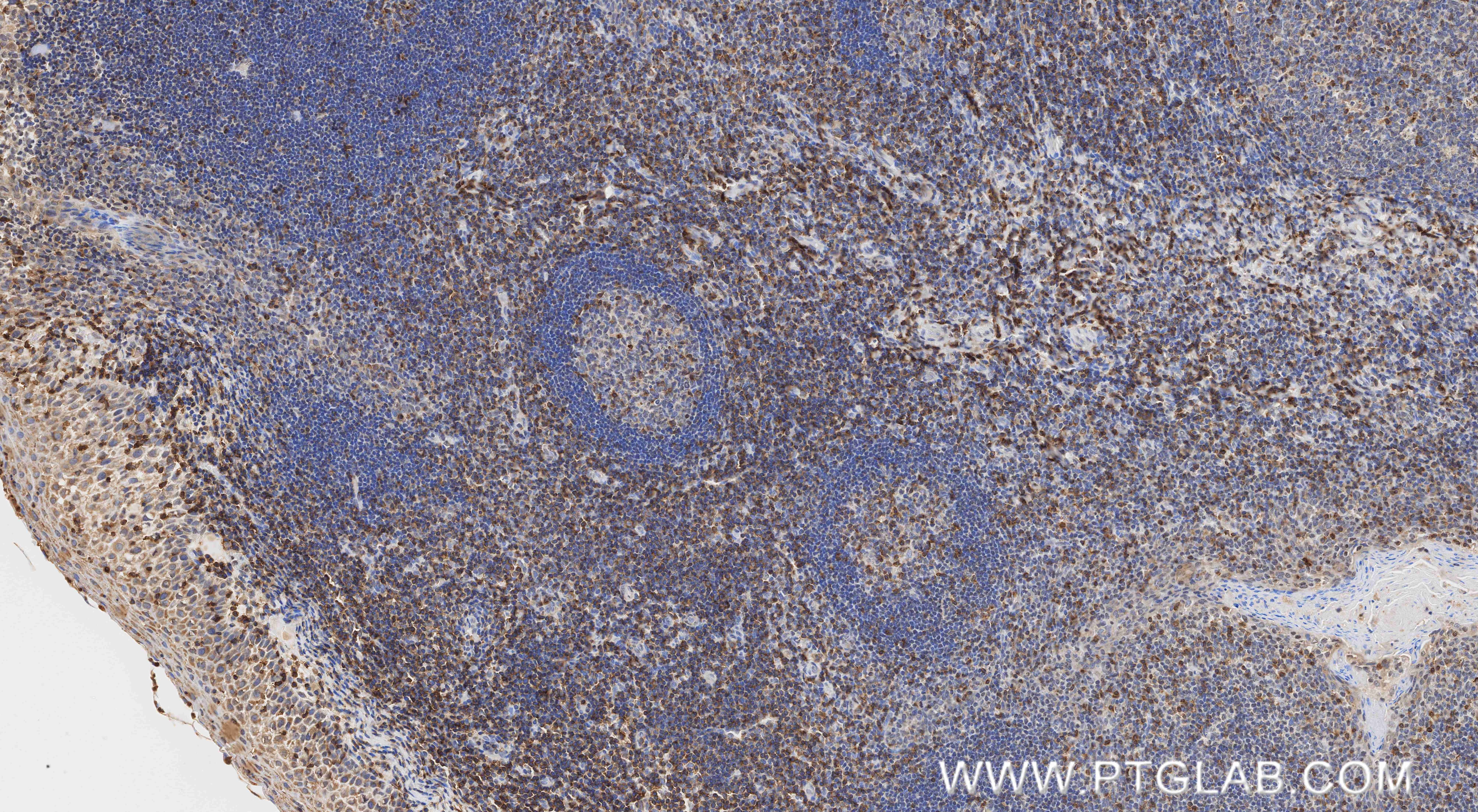 Immunohistochemistry (IHC) staining of human tonsillitis tissue using Anti-Human CD3 Mouse Recombinant Antibody (98319-2-MR)