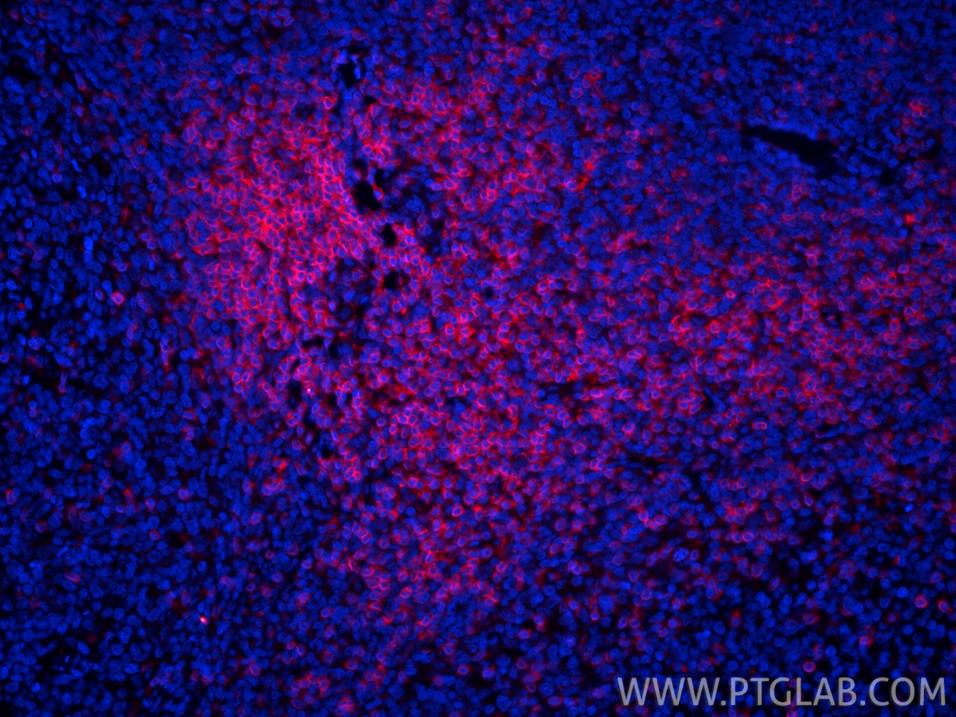IF Staining of human tonsillitis using CL594-81324 Immunofluorescence (IF) / fluorescent staining of human tonsillitis tissue using CoraLite®594-conjugated CD3 Recombinant monoclonal (CL594-81324)