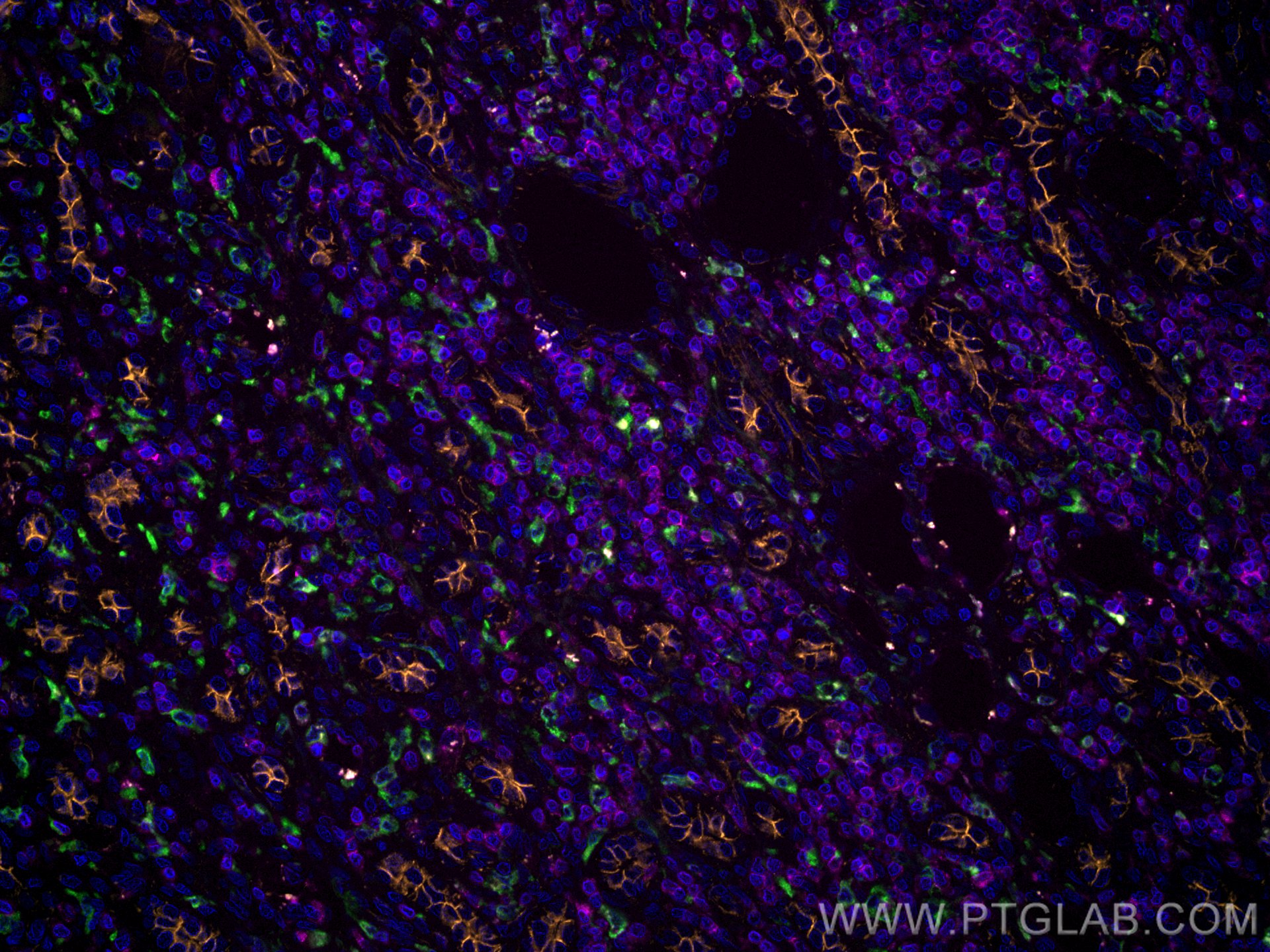 IF Staining of human liver cancer using CL647-60181