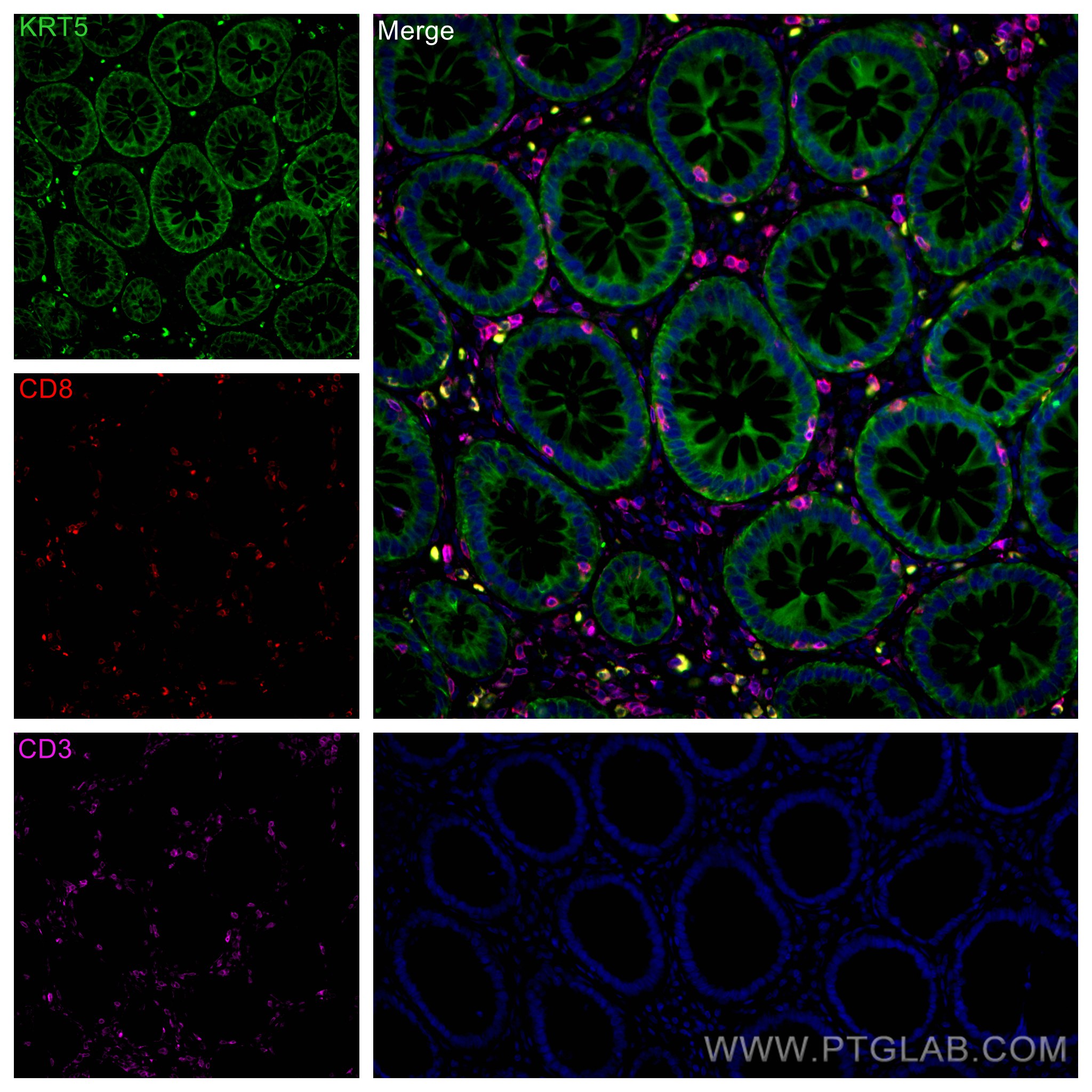 Immunofluorescence (IF) / fluorescent staining of human colon cancer tissue using CoraLite® Plus 647-conjugated CD3 Monoclonal antib (CL647-60181)