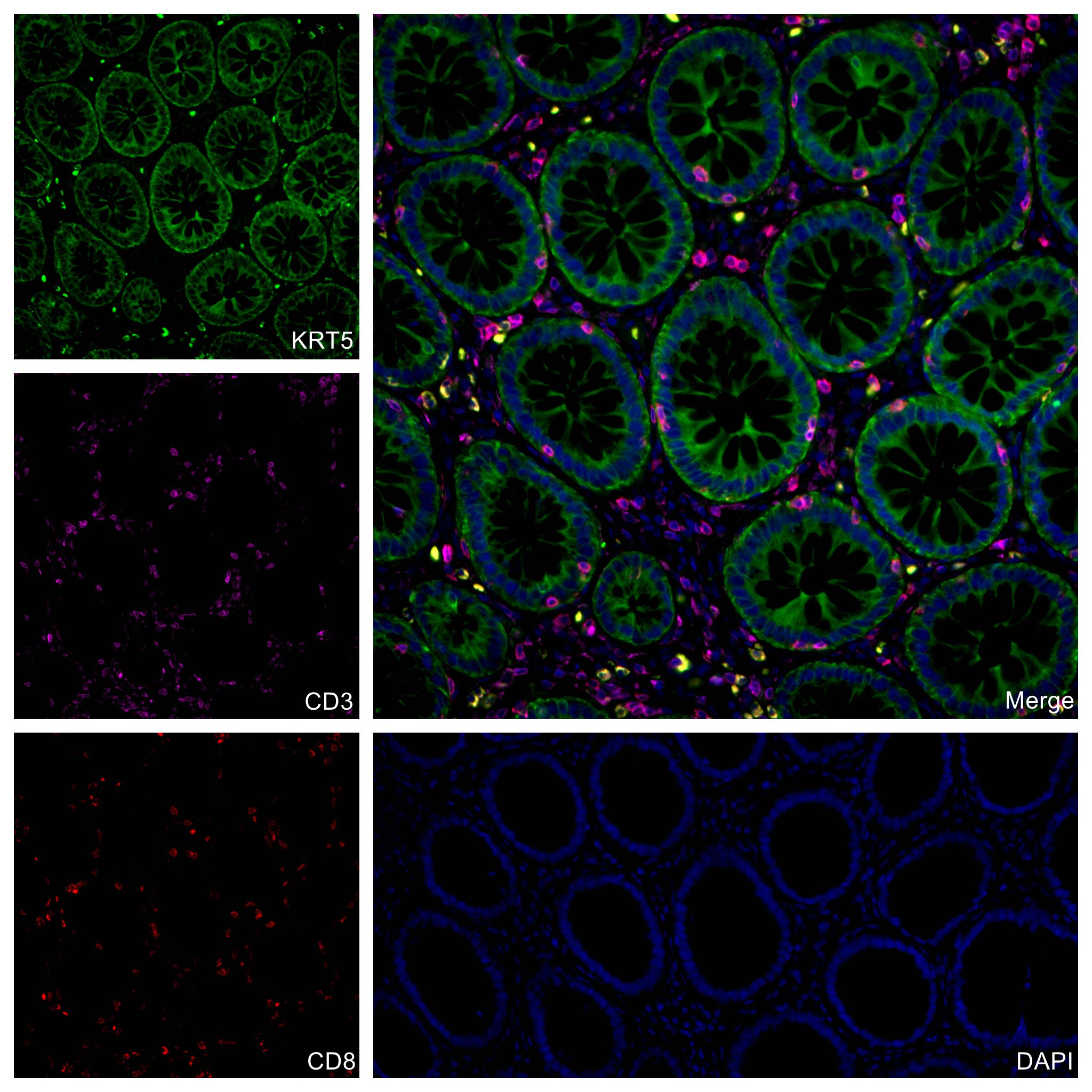 Immunofluorescence (IF) / fluorescent staining of human colon cancer tissue using CoraLite® Plus 647-conjugated CD3 Monoclonal antib (CL647-60181)