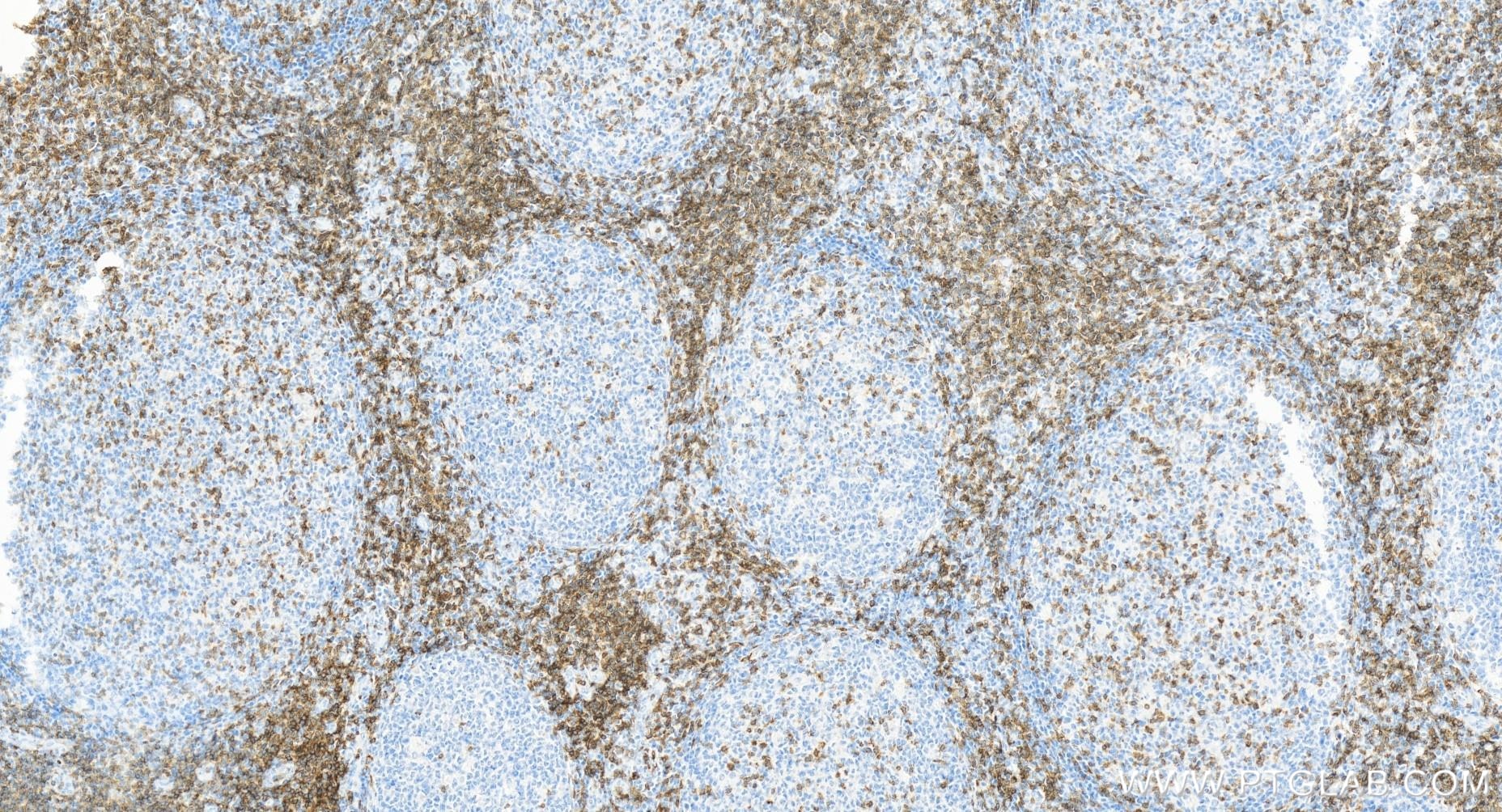 Immunohistochemistry (IHC) staining of human tonsillitis tissue using CD3 Gamma Recombinant antibody (84836-2-RR)