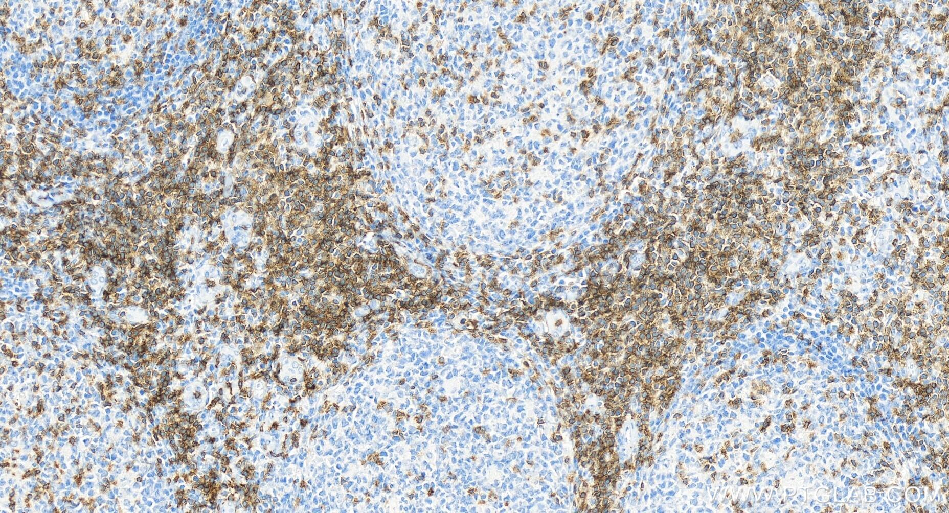 Immunohistochemistry (IHC) staining of human tonsillitis tissue using CD3 Gamma Recombinant antibody (84836-2-RR)